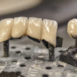 Cost of Porcelain Crown in Avondale, AZ