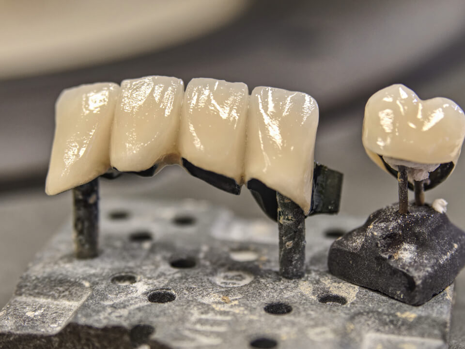 Cost of Porcelain Crown in Avondale, AZ