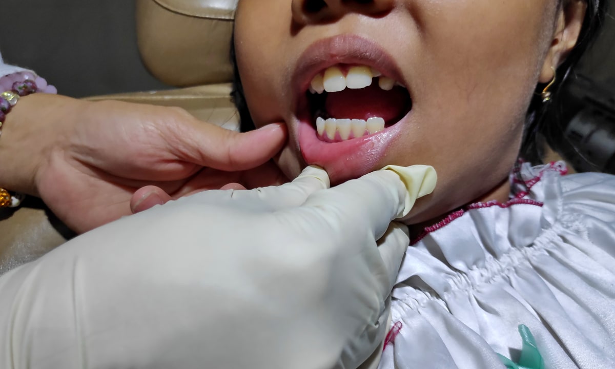 How Much Do Dental Abscess Treatments Cost in Avondale, AZ?