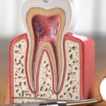 How to Know If You Need a Root Canal Treatment?