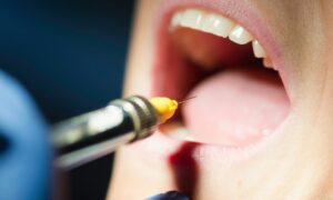 Cracked Tooth Repair Cost in Avondale, AZ