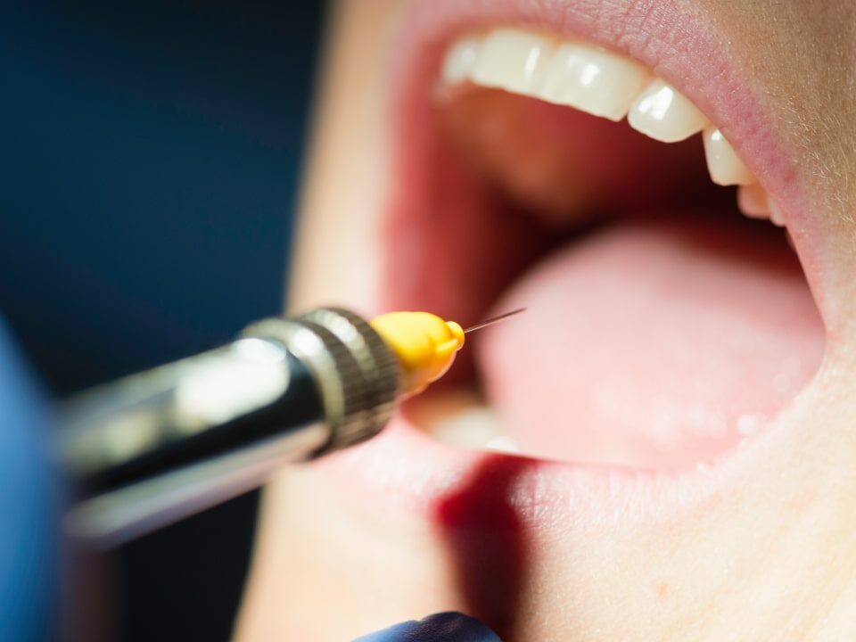 Cracked Tooth Repair Cost in Avondale, AZ