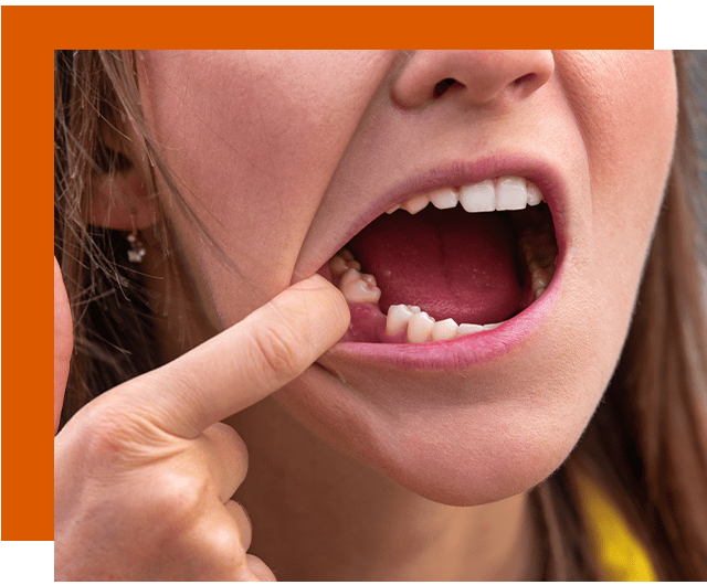 Desert Lake Dental Tooth Extraction