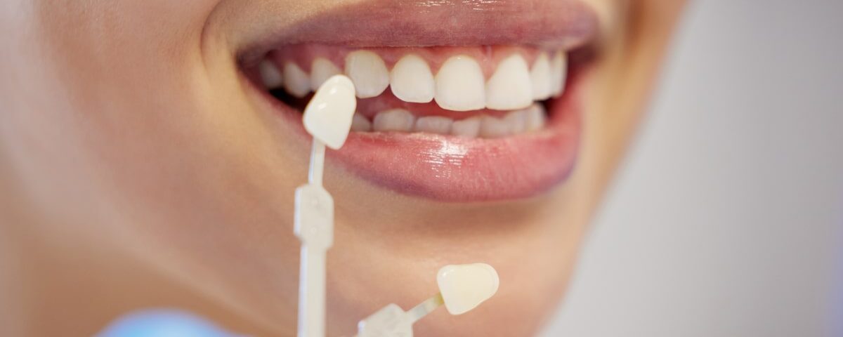 How Much Do Dental Veneers Cost in Avondale, AZ