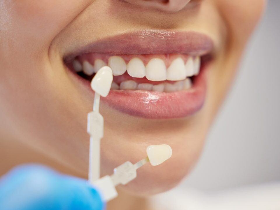 How Much Do Dental Veneers Cost in Avondale, AZ