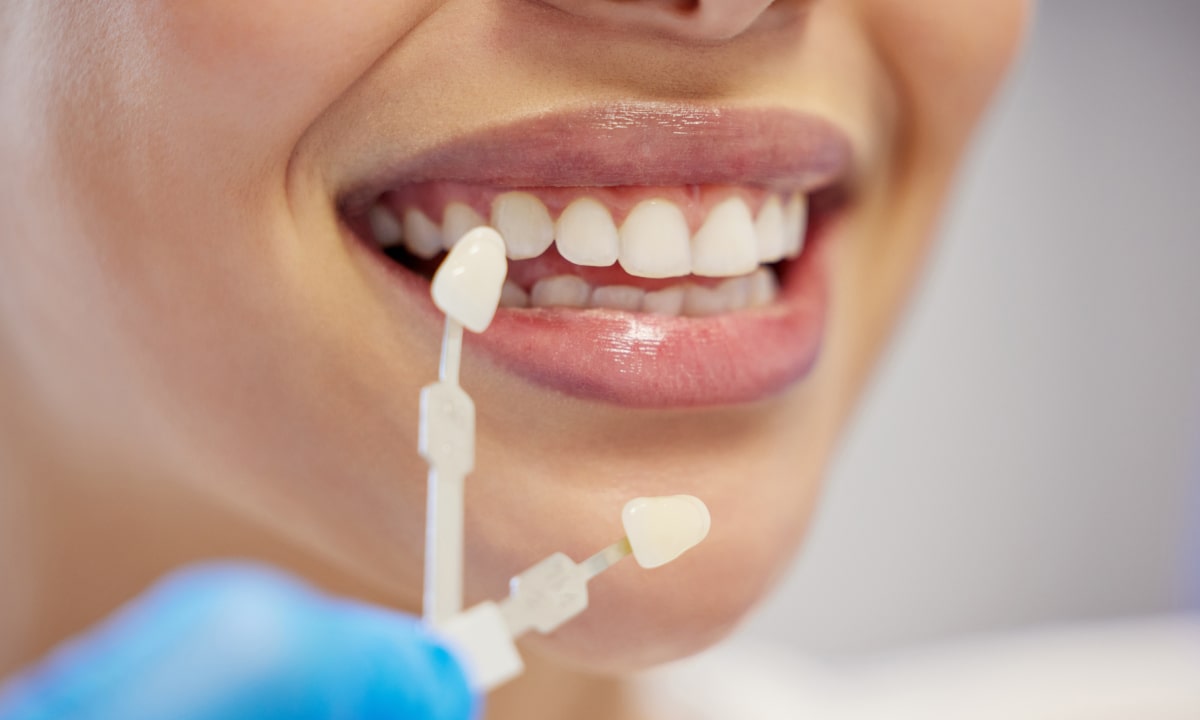 How Much Do Dental Veneers Cost in Avondale, AZ