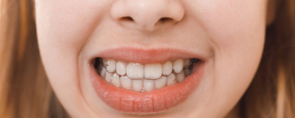 How Much Does It Cost to Remove White Stains on Teeth in Avondale