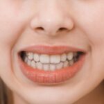 How Much Does It Cost to Remove White Stains on Teeth in Avondale