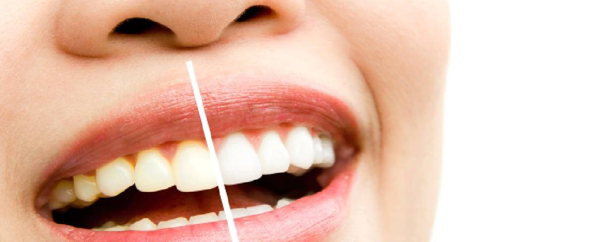 Teeth Whitening Cost in Avondale, AZ