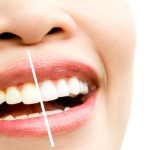Teeth Whitening Cost in Avondale, AZ