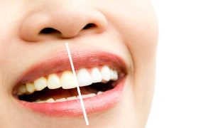 Teeth Whitening Cost in Avondale, AZ
