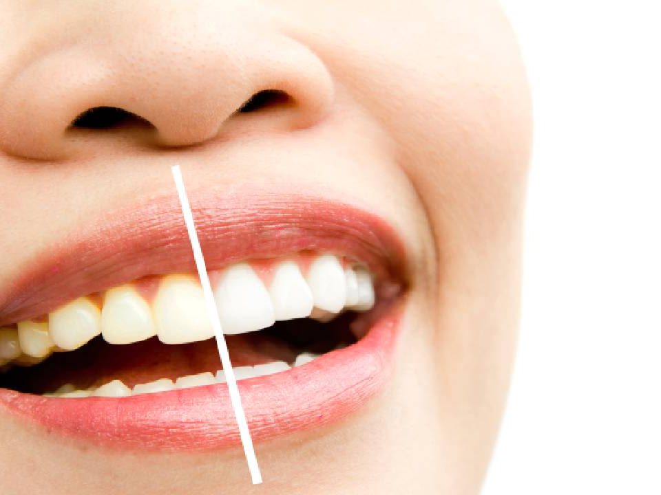 Teeth Whitening Cost in Avondale, AZ