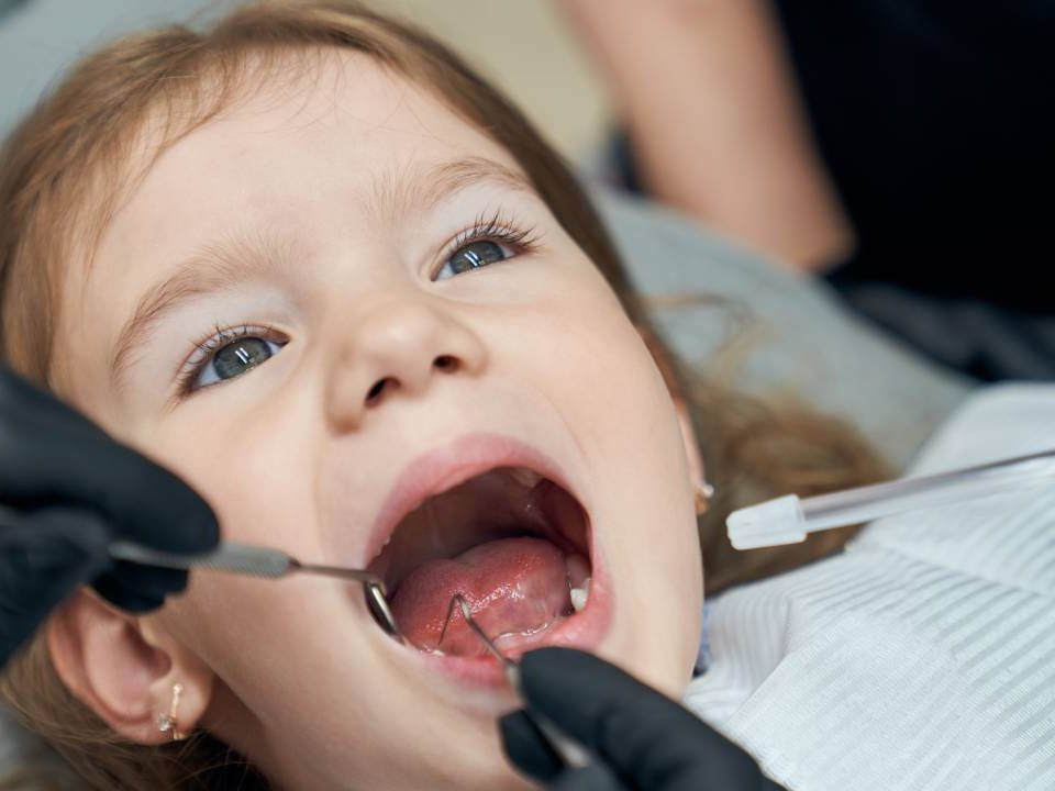 Should You Fill Cavities in Baby Teeth