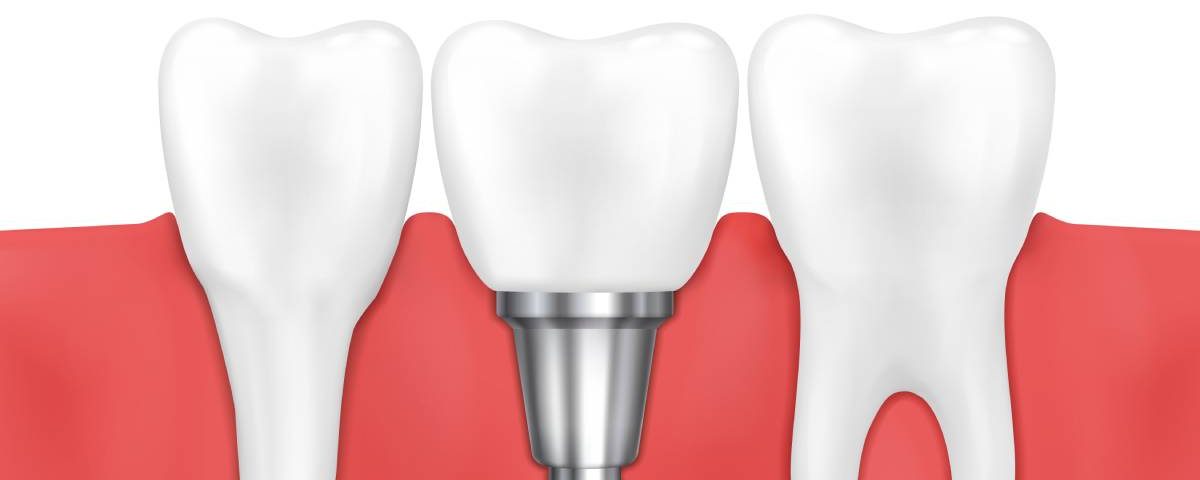 Are Single Tooth Dental Implants Painful