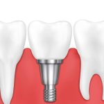 Are Single Tooth Dental Implants Painful