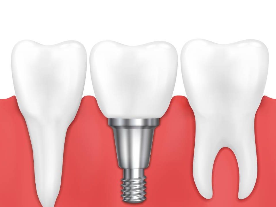 Are Single Tooth Dental Implants Painful