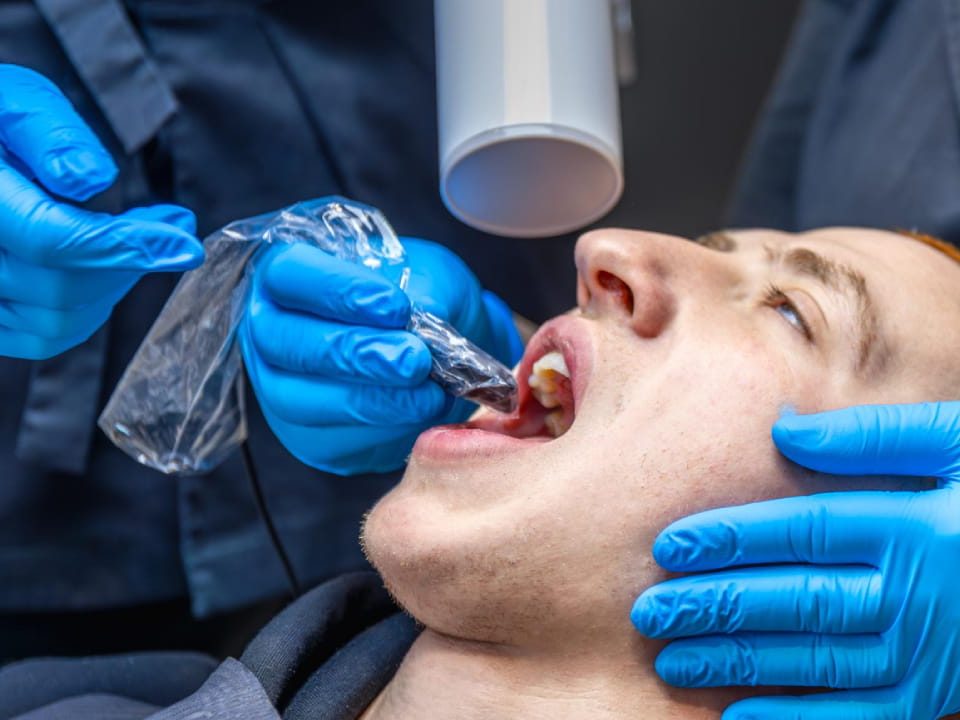 What Do Dentists Use to Fill Cavities?