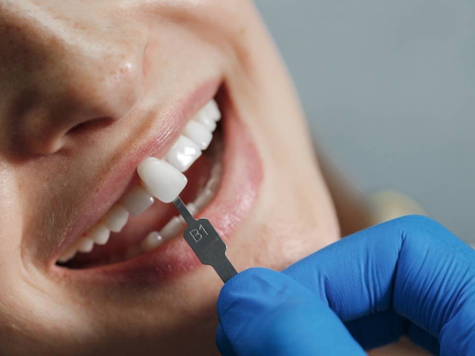 How Strong are Porcelain Crowns